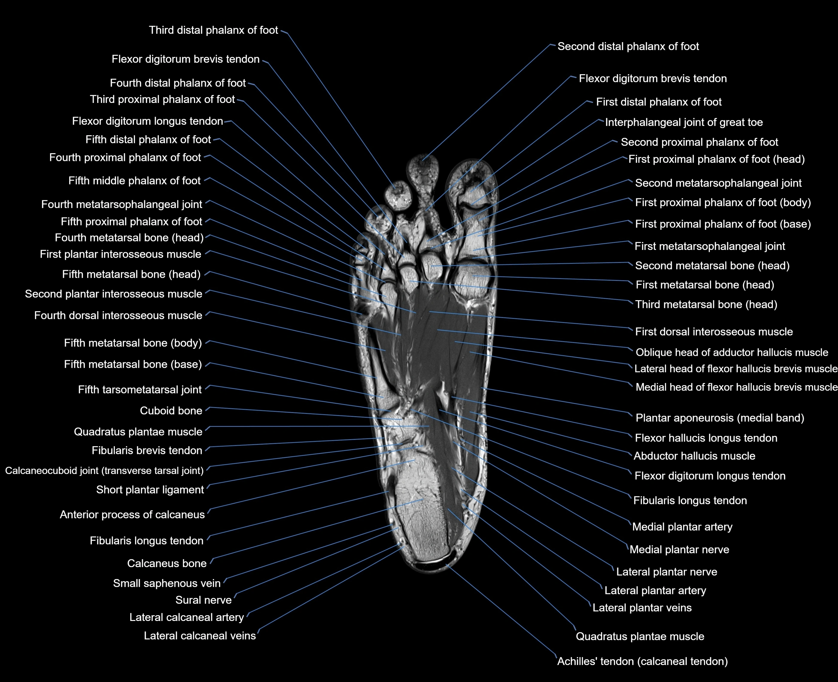 MRI foot coronal cross sectional anatomy 3T  radiology  image-img-00001-00023.webp